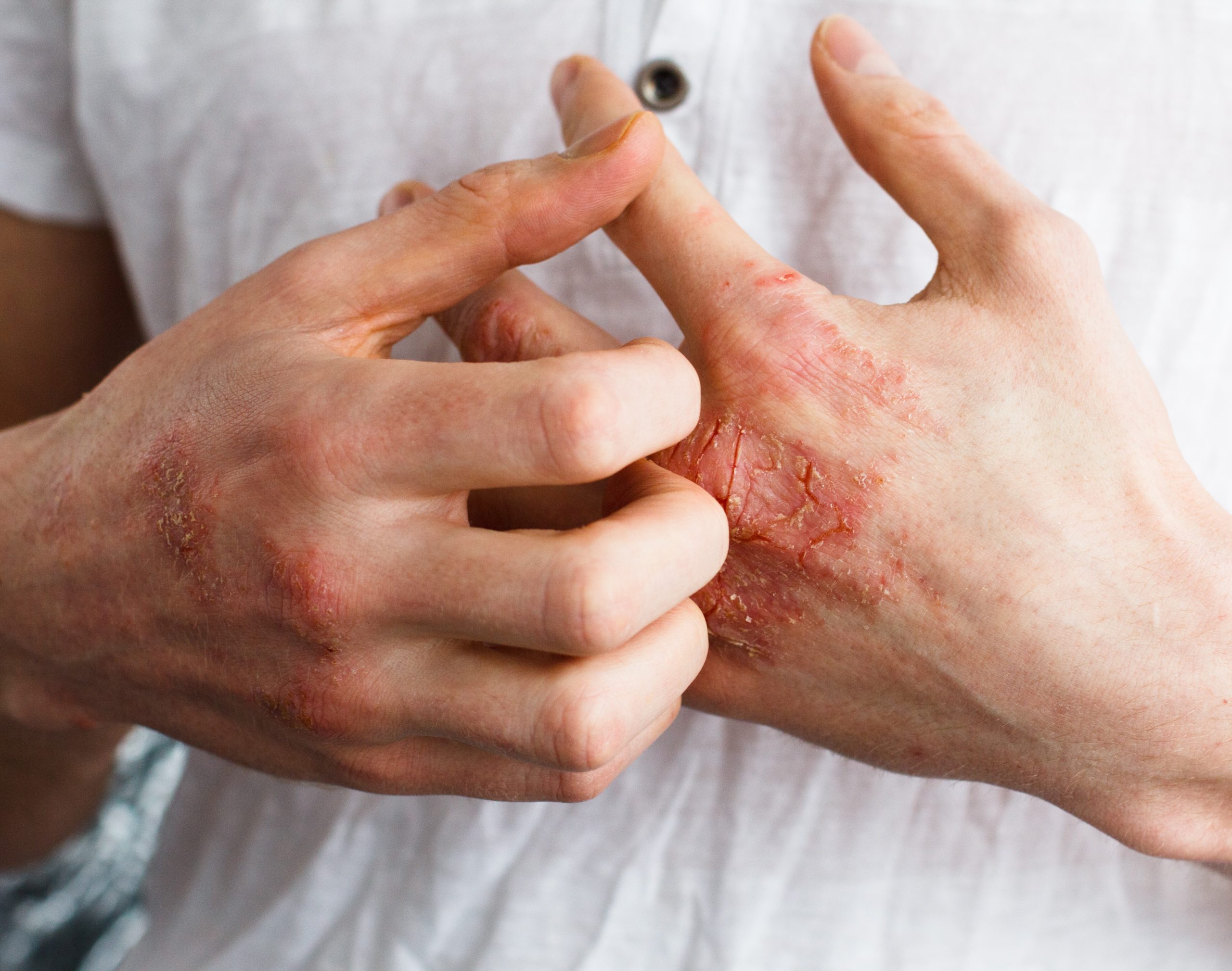 A person with red spots on their skin.
