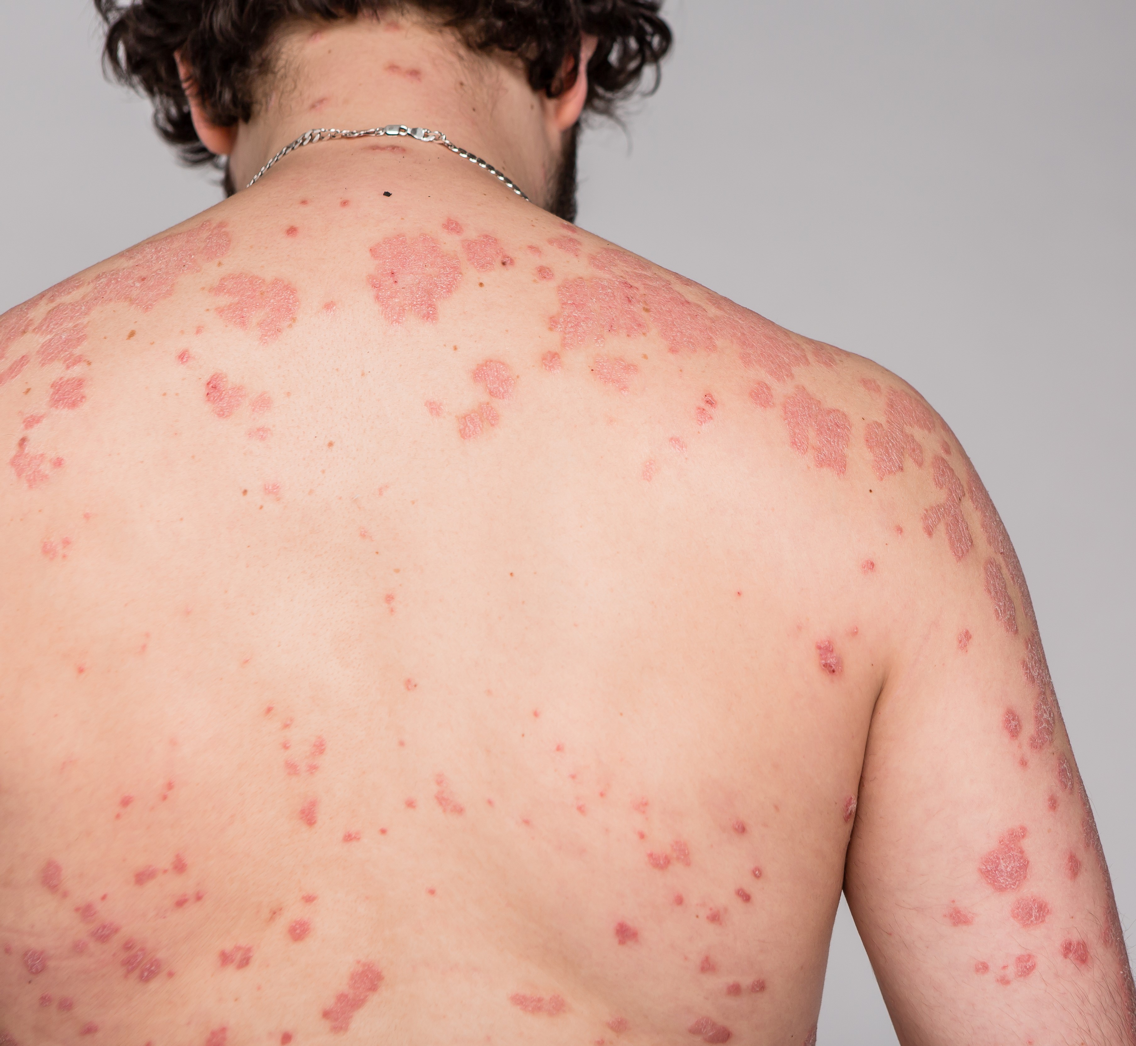 A man with red spots on his back and arms.
