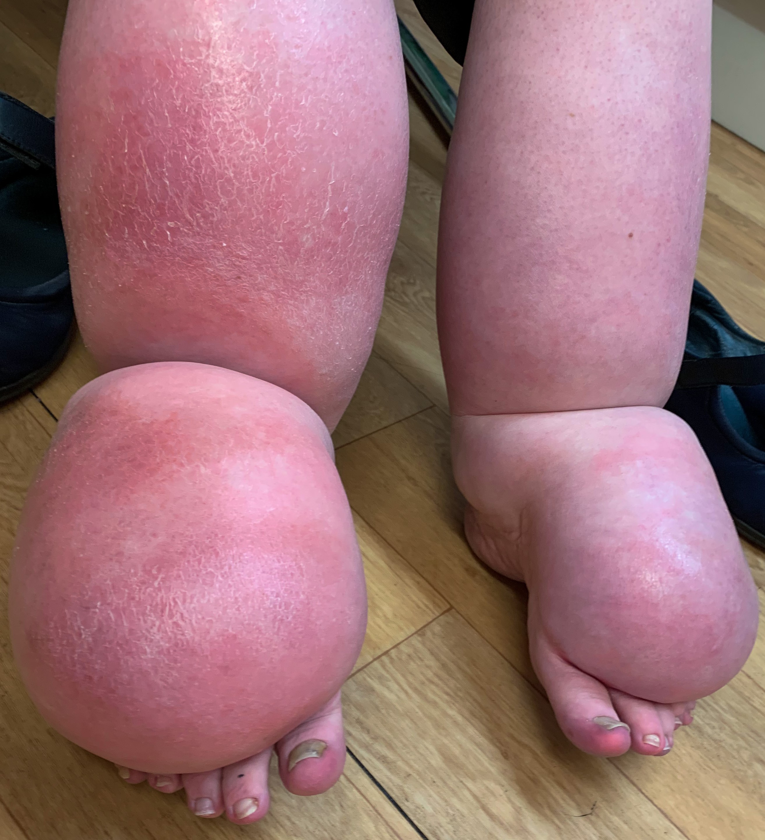 A person with large legs and feet covered in red skin.