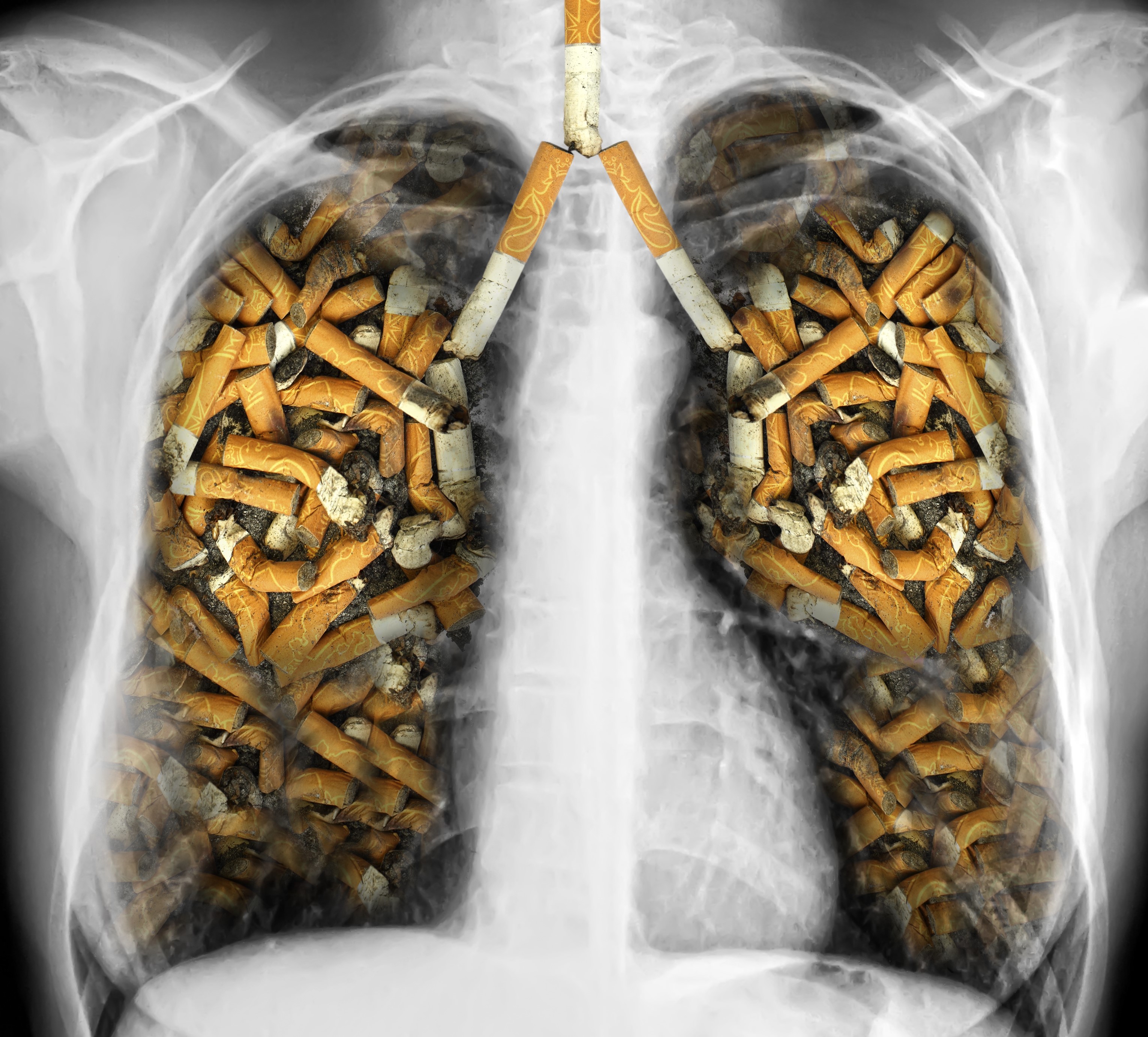 A picture of an x-ray showing cigarettes in the lungs.